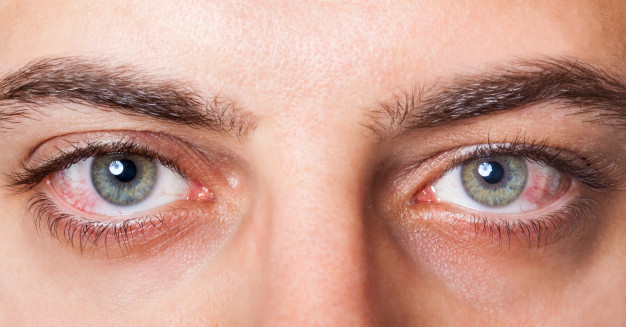 Conjuntivitis, cómo tratarla